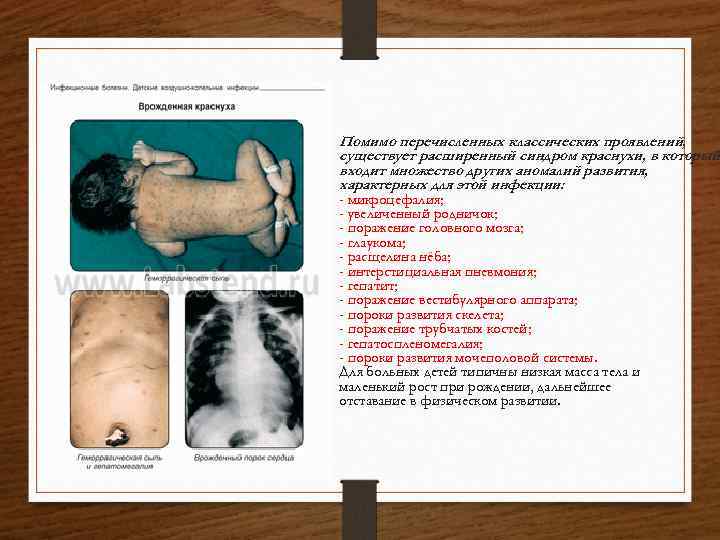 Помимо перечисленных классических проявлений, существует расширенный синдром краснухи, в который входит множество других аномалий