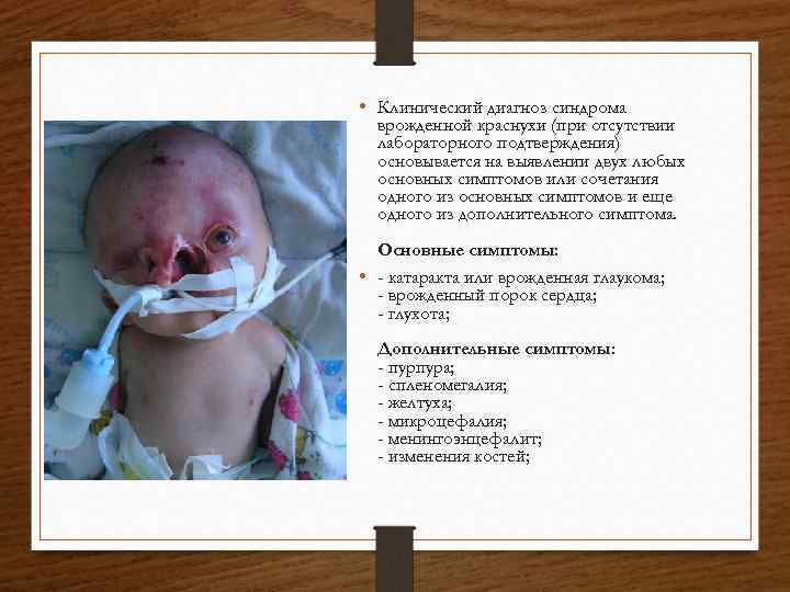  • Клинический диагноз синдрома врожденной краснухи (при отсутствии лабораторного подтверждения) основывается на выявлении
