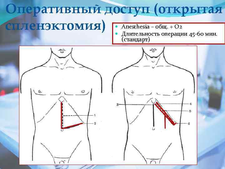 Оперативный доступ (открытая спленэктомия) Anesthesia – общ. + О 2 Длительность операции 45 -60