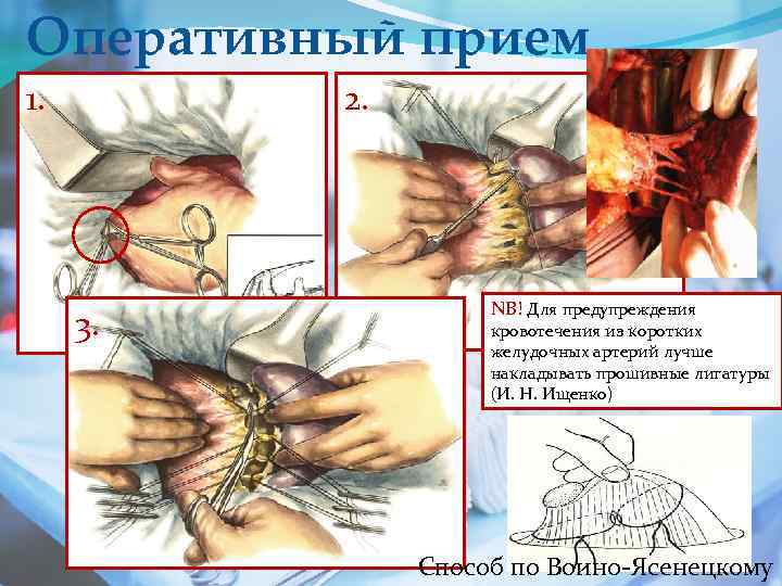 Оперативный прием 1. 2. 3. NB! Для предупреждения кровотечения из коротких желудочных артерий лучше