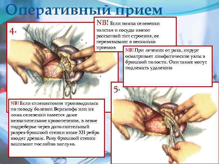 Оперативный прием 4. NB! Если ножка селезенки толстая и сосуды имеют рассыпной тип строения,