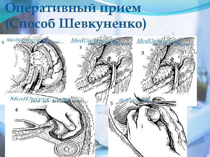 Оперативный прием (Способ Шевкуненко) 1 2 3 5 4 