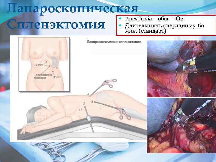 Лапароскопическая Anesthesia – общ. + О 2 Спленэктомия Длительность операции 45 -60 мин. (стандарт)