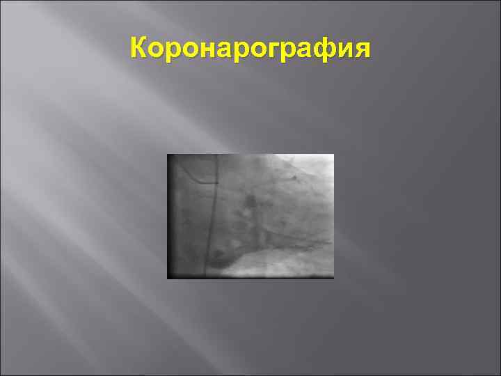 Коронарография 