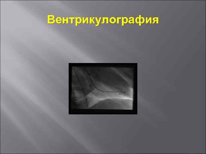 Вентрикулография 