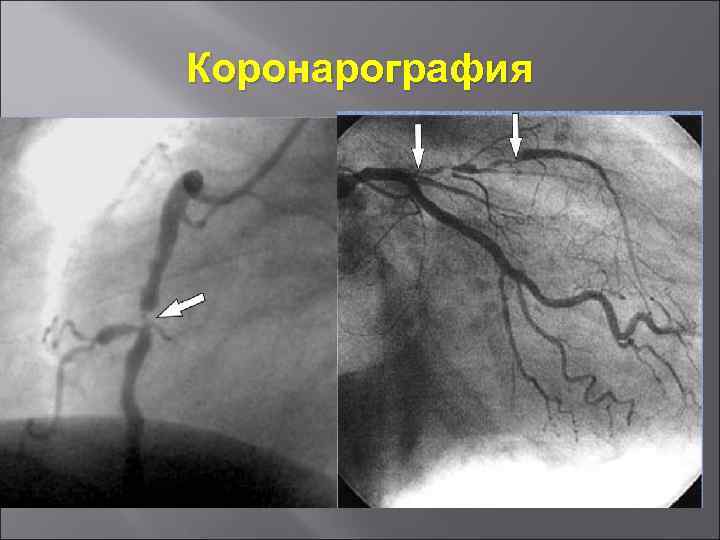 Коронарография 