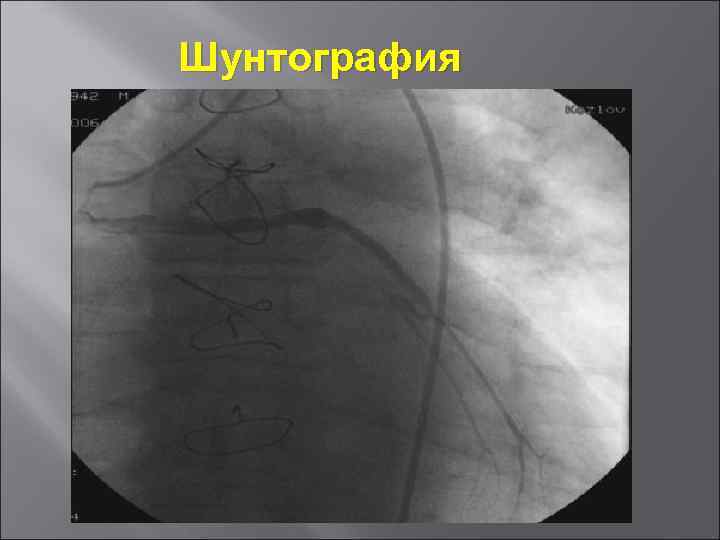 Шунтография 