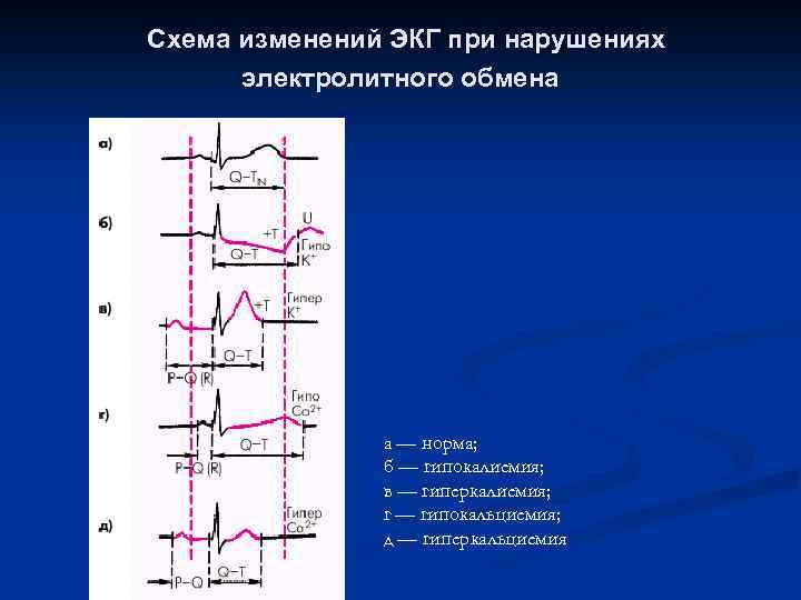 Метаболические изменения на экг