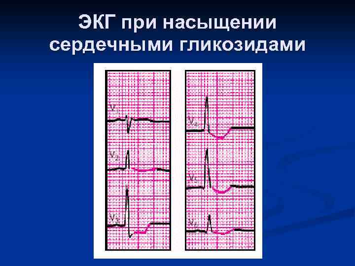 ЭКГ при насыщении сердечными гликозидами 