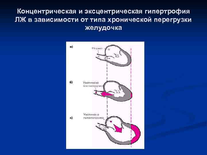 Концентрическая и эксцентрическая гипертрофия