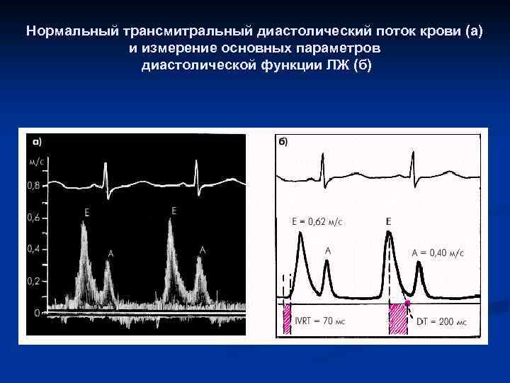 Нормальный трансмитральный диастолический поток крови (а) и измерение основных параметров диастолической функции ЛЖ (б)