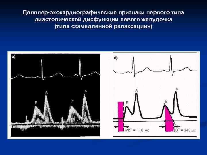 Дисфункция левого желудочка. Типы нарушения диастолической функции лж. Диастолическая дисфункция лж по 1 типу по ЭХОКГ. Диастолическая дисфункция левого желудочка на ЭХОКГ. Диастолическая функция лж.