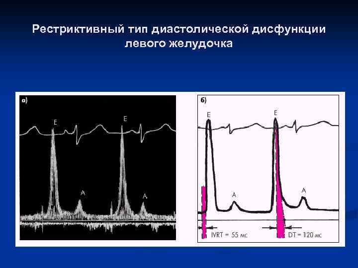 Диастолическая дисфункция левого