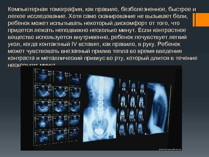 Компьютерная томография, как правило, безболезненное, быстрое и легкое исследование. Хотя само сканирование не вызывает