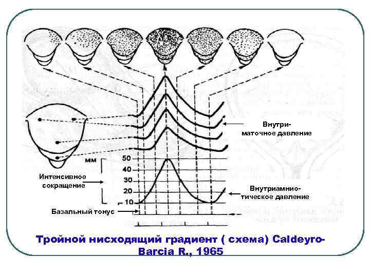 Внутриматочное давление Интенсивное сокращение Внутриамниотическое давление Базальный тонус Тройной нисходящий градиент ( схема) Caldeyro.