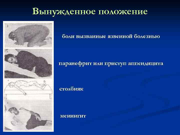 Вынужденное положение боли вызванные язвенной болезнью паранефрит или приступ аппендицита столбняк менингит 