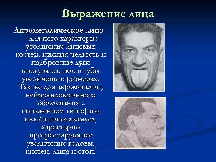 Выражение лица Акромегалическое лицо – для него характерно утолщение лицевых костей, нижняя челюсть и