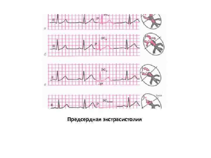 Предсердная экстрасистолия 