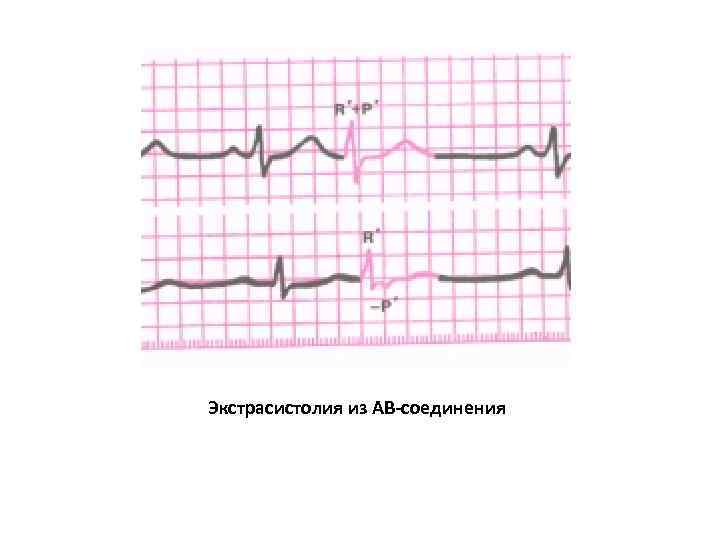 Экстрасистолия из АВ-соединения 