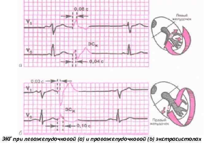 ЭКГ при левожелудочковой (а) и правожелудочковой (б) экстрасистолах 