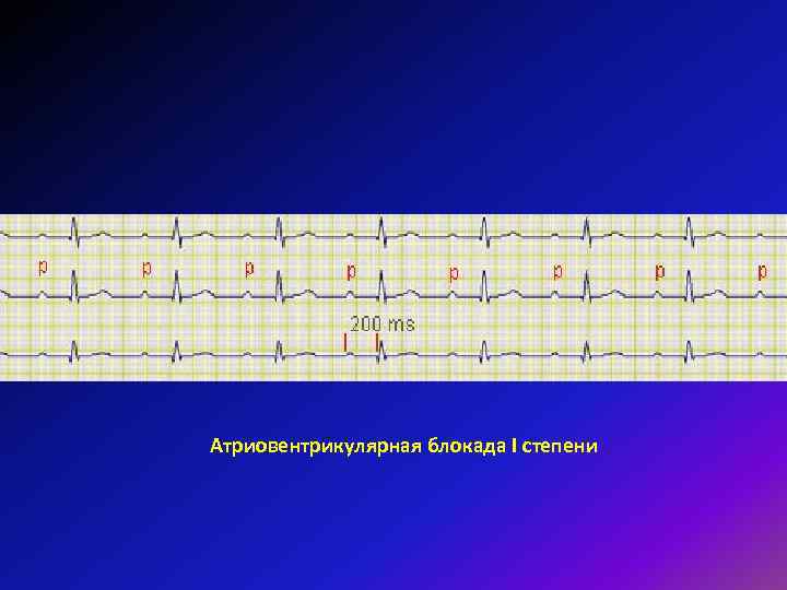 Атриовентрикулярная блокада I степени 