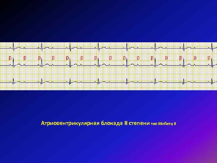 Атриовентрикулярная блокада II степени тип Мобитц II 