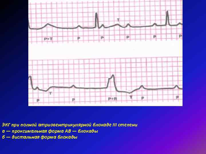 ЭКГ при полной атриовентрикулярной блокаде III степени а — проксимальная форма АВ — блокады