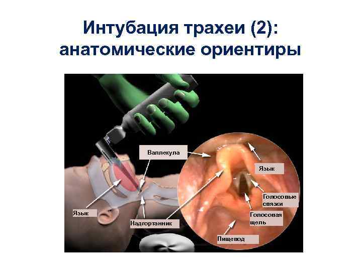 Интубация трахеи (2): анатомические ориентиры Валлекула Язык Голосовые связки Язык Голосовая щель Надгортанник Пищевод