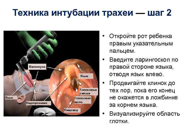 Техника интубации трахеи — шаг 2 Валлекула Язык Голосовые связки Язык Надгортанник Голосовая щель