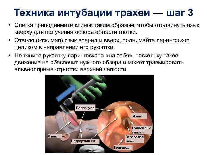 Техника интубации трахеи — шаг 3 • Слегка приподнимите клинок таким образом, чтобы отодвинуть