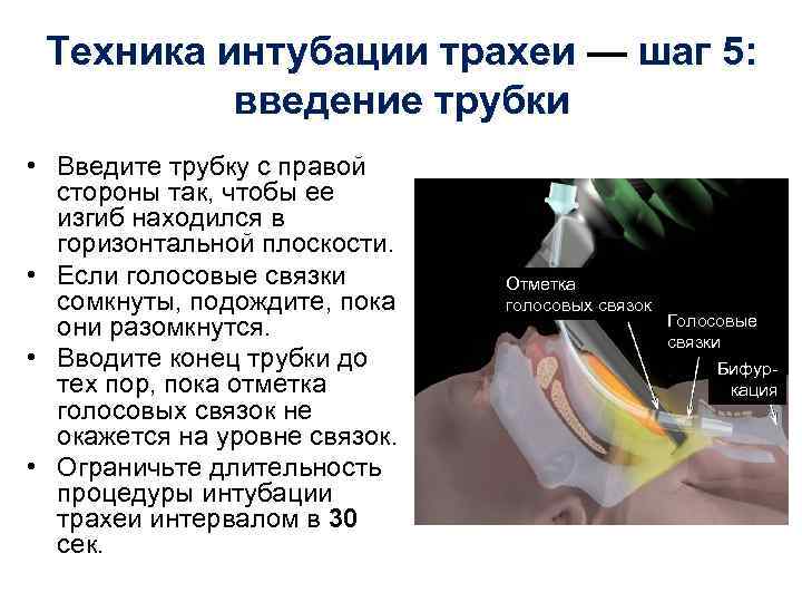 Техника интубации трахеи — шаг 5: введение трубки • Введите трубку с правой стороны