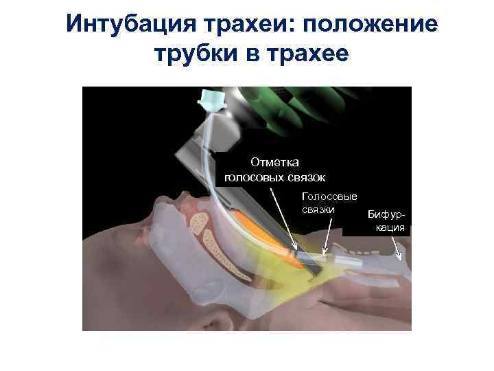 Интубация трахеи: положение трубки в трахее Отметка голосовых связок Голосовые связки Бифуркация 