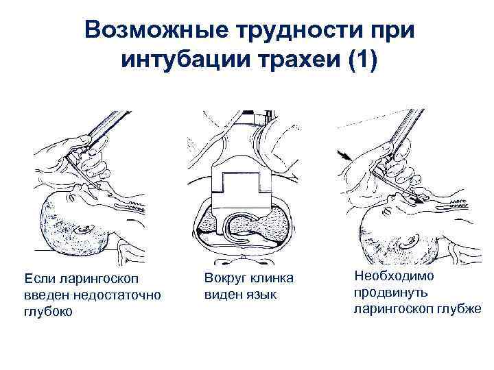 Возможные трудности при интубации трахеи (1) Если ларингоскоп введен недостаточно глубоко Вокруг клинка виден