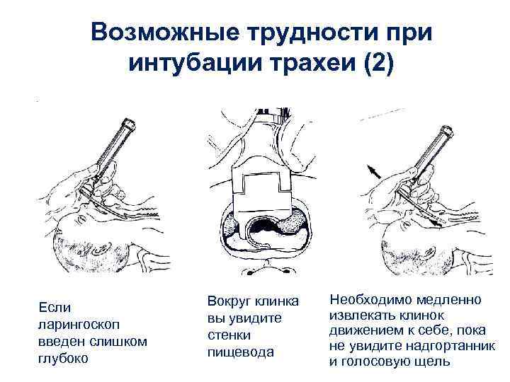 Возможные трудности при интубации трахеи (2) Если ларингоскоп введен слишком глубоко Вокруг клинка вы