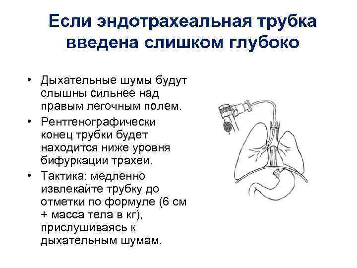 Если эндотрахеальная трубка введена слишком глубоко • Дыхательные шумы будут слышны сильнее над правым