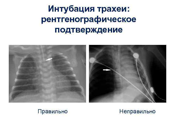 Интубация трахеи: рентгенографическое подтверждение Правильно Неправильно 