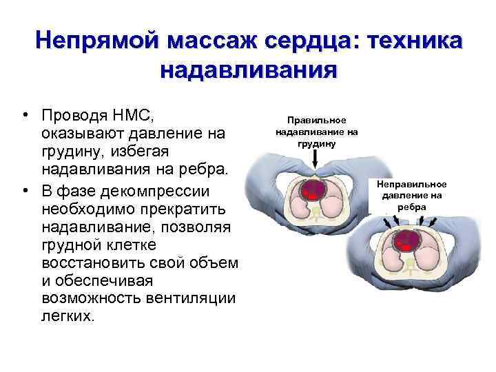 Непрямой массаж сердца: техника надавливания • Проводя НМС, оказывают давление на грудину, избегая надавливания