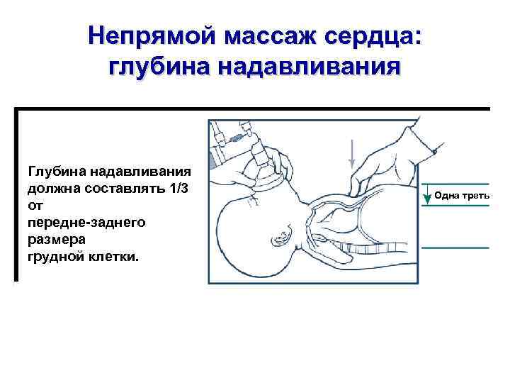 Непрямой массаж сердца: глубина надавливания Глубина надавливания должна составлять 1/3 от передне-заднего размера грудной