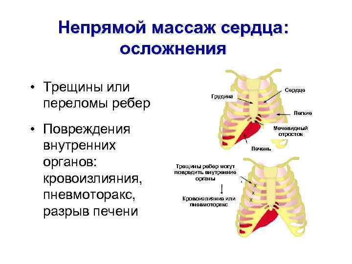 Непрямой массаж сердца: осложнения • Трещины или переломы ребер • Повреждения внутренних органов: кровоизлияния,