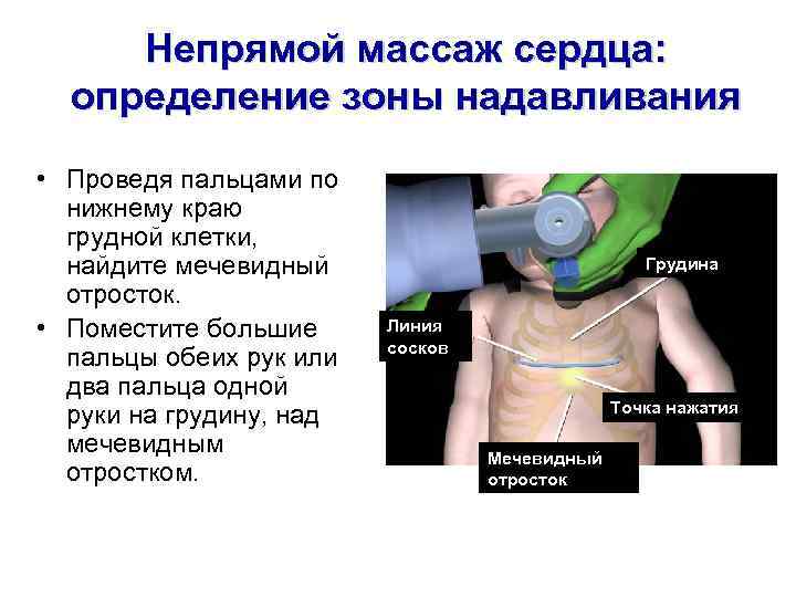 Непрямой массаж сердца: определение зоны надавливания • Проведя пальцами по нижнему краю грудной клетки,