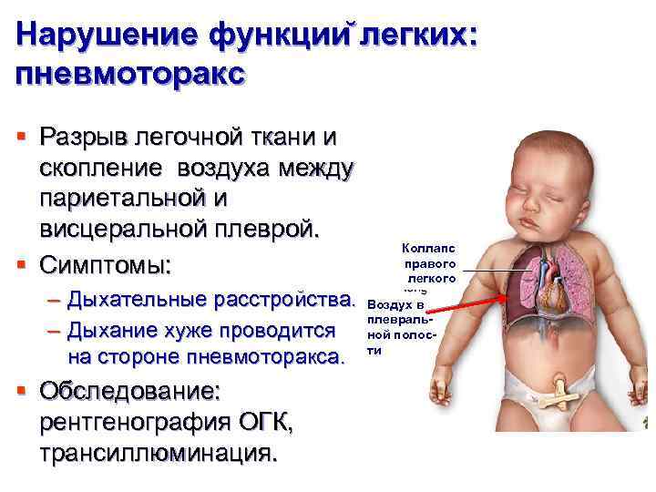 Нарушение функции легких: пневмоторакс § Разрыв легочной ткани и скопление воздуха между париетальной и