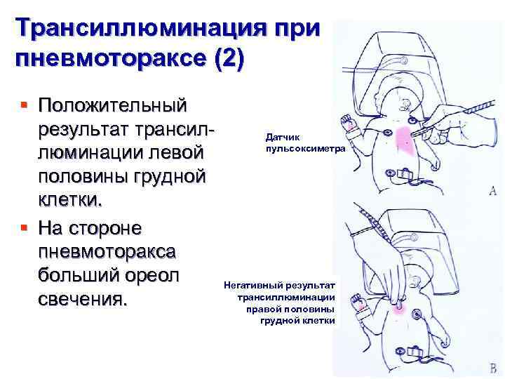 Трансиллюминация при пневмотораксе (2) § Положительный результат трансиллюминации левой половины грудной клетки. § На