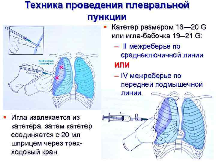 Техника проведения плевральной пункции § Катетер размером 18— 20 G или игла-бабочка 19— 21