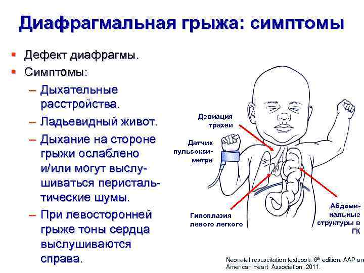 Диафрагмальная грыжа клиническая картина