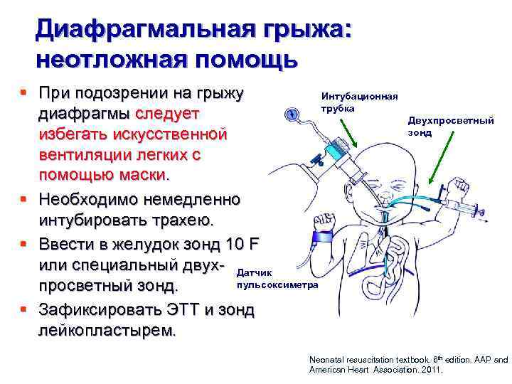 Каша при диафрагмальной грыже