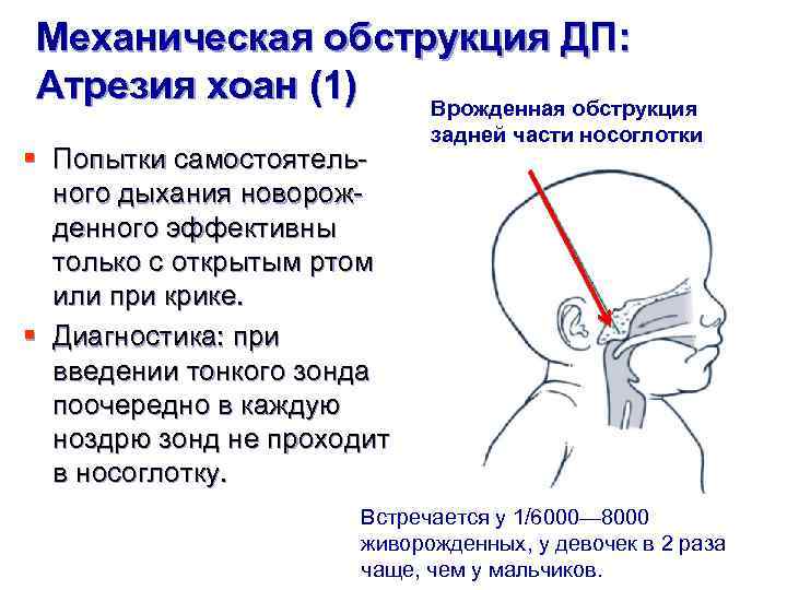 Механическая обструкция ДП: Атрезия хоан (1) Врожденная обструкция § Попытки самостоятельного дыхания новорожденного эффективны