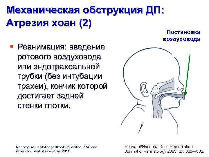 Механическая обструкция ДП: Атрезия хоан (2) § Реанимация: введение ротового воздуховода или эндотрахеальной трубки