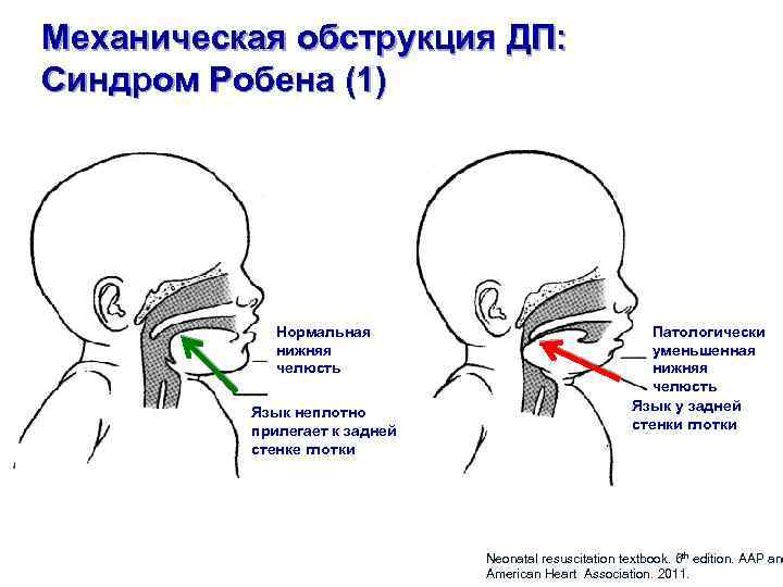 Механическая обструкция ДП: Синдром Робена (1) Нормальная нижняя челюсть Язык неплотно прилегает к задней