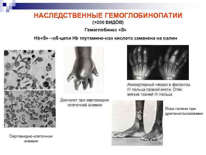НАСЛЕДСТВЕННЫЕ ГЕМОГЛОБИНОПАТИИ (>200 ВИДОВ) Гемоглобиноз «S» Hb «S» →вß-цепи Hb глутамино-вая кислота заменена на
