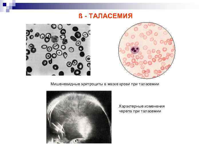 ß - ТАЛАСЕМИЯ Мишеневидные эритроциты в мазке крови при таласемии Характерные изменения черепа при